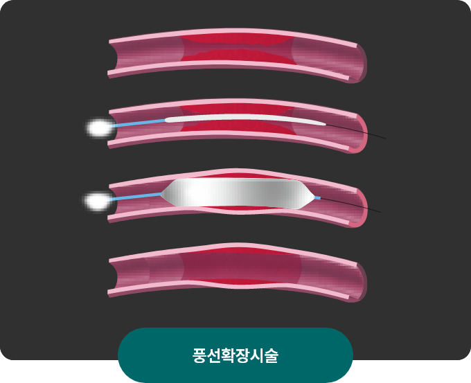 투석혈관 중재시술 이미지