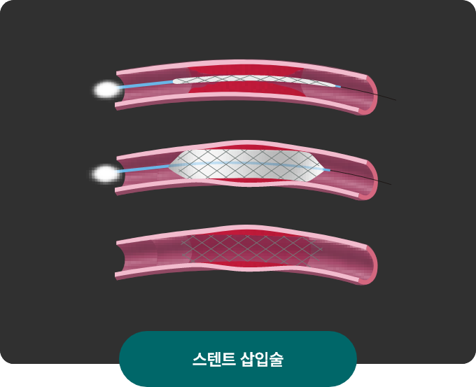 투석혈관 중재시술 이미지